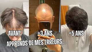 Miniature : 5 Ans de Finasteride et Minoxidil - Ce que j Aurais Voulu Savoir dès le Début