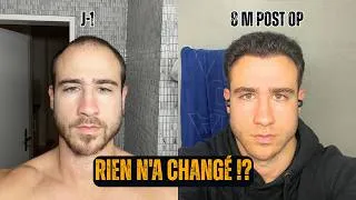 Miniature : Greffe de Cheveux à 23 Ans — 8 Mois Plus Tard, Voici la Vérité
