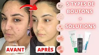 Miniature : L'ACNÉ : MA ROUTINE SKINCARE + TOUTES LES SOLUTIONS POUR CHAQUE TYPE DE BOUTON !