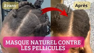 Miniature : COMMENT SOIGNER NATURELLEMENT SES PELLICULES ? 👩🏻‍🦱 | MASQUE  NATUREL ( 2 ingrédients)👌
