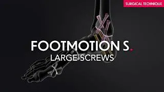 Miniature : Footmotion S - Large Screws - Headless stand-alone screws from small to large fragments