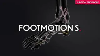Miniature : Footmotion S - Headless stand-alone screws from small to large fragments - Surgical technique