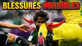 Miniature : Les 10 blessures les plus HORRIBLES de l'histoire de la Coupe du Monde