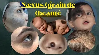 Miniature : Quand faut-il enlever un grain de beauté? Faut-il simplement surveiller ou consulter un spécialiste?