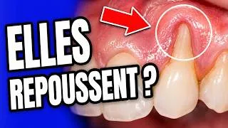 Miniature : Peut-On Faire Repousser Les Gencives ? La Réponse Va Te Surprendre