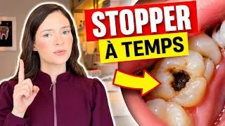 Miniature : Peut-on Stopper Une Carie À La Maison ? Ce Qu’Internet Ne Dit Pas