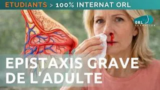 Miniature : Epistaxis grave de l'adulte | 100% Internat ORL | Episode #3