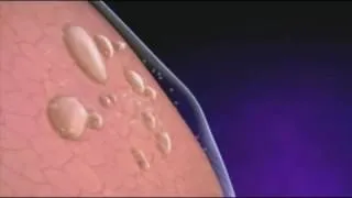 Miniature : Un Pneumothorax