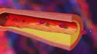 Miniature : Infarctus du myocarde