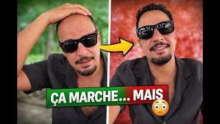 Miniature : J’ai récupéré mes cheveux sans greffe… mais à quel prix ? 😳 (Finastéride vs Dutastéride)