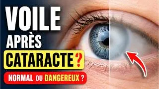 Miniature : Voile sur l'Œil après Opération de la Cataracte : les Vraies Causes (et Quand s'Inquiéter Vraiment)