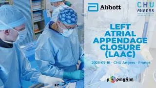 Miniature : Left Atrial Appendage Closure (LAAO) with ICE – Live Case CHU Angers | Fermeture auricule gauche