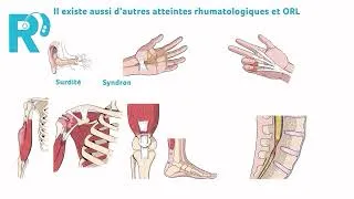 Miniature : Arthrose qui se dégrade trop vite ? Et si c'était une amylose cardiaque 1