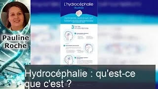 Miniature : Tout savoir sur l'hydrocéphalie : causes, symptômes et traitements expliqués !