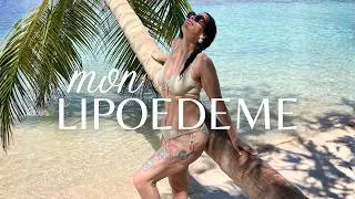 Miniature : LIPOEDEME :  1 femme sur 10 est atteinte de cette maladie, c'est peut-être votre cas