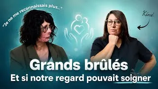 Miniature : "Grande brûlée : son témoignage bouleversant sur l'après, et comment votre regards peut soigner !