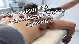 Miniature : Cupping therapy : pourquoi les athlètes en sont accros ?