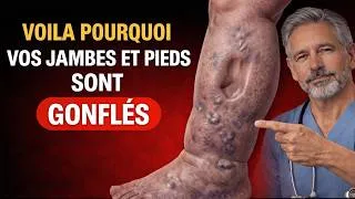 Miniature : Jambes et Pieds Gonflés ? Si la Marque du Doigt Reste, Regarde Ça MAINTENANT