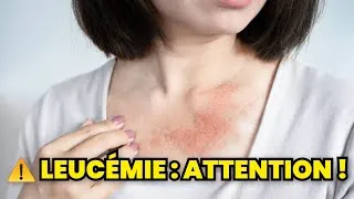 Miniature : 🚨 Leucémie : les symptômes qui doivent vous alerter immédiatement