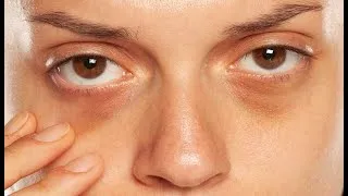 Miniature : Comment se débarrasser des cernes sous les yeux