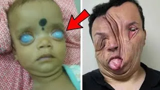 Miniature : Est-ce réel ? 10 humains qui vivent avec des visages presque irréels!