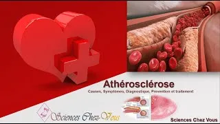 Miniature : Athérosclérose