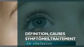 Miniature : Le chalazion  : Que faire face  causes, symptômes et traitement.
