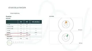 Miniature : De l'instabilité à la précision : évolution de la fixation chez un adolescent