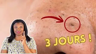 Miniature : Pourquoi tes points noirs reviennent en 3 jours
