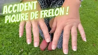Miniature : Frelon asiatique dans une jarre, ACCIDENT:  piqure à la main