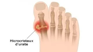 Miniature : LA GOUTTE