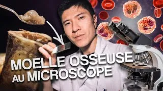 Miniature : On observe une leucémie au microscope !