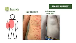 Miniature : PSORIASIS : Témoignage photo bras et torse