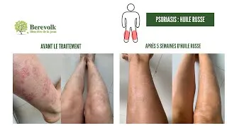 Miniature : Psoriasis aux jambes : Stéphanie traite son psoriasis naturellement