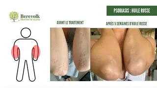 Miniature : Stéphanie a traité son psoriasis aux coudes avec des produits naturels
