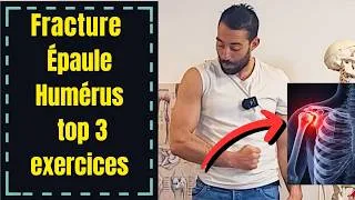 Miniature : Fracture de l’humérus / épaule : 3 exercices pour récupérer l’épaule rapidement et éviter la raideur