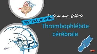 Miniature : Urgences - la lecon avec cedille - Thrombophlébite cérébrale 🗣️💀💡