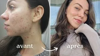 Miniature : Acné hormonale : Comment je l'ai soignée 100% naturellement