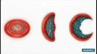 Miniature : Hémoglobinopathies   Au Cœur des Mutations du Sang