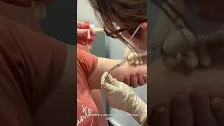 Miniature : Biopsie cutanée version adulte.