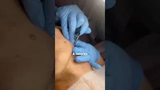 Miniature : Glow up de ma peau, update et résultats