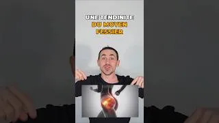 Miniature : TENDINITE DU MOYEN FESSIER :  Un exercice pour se soigner !