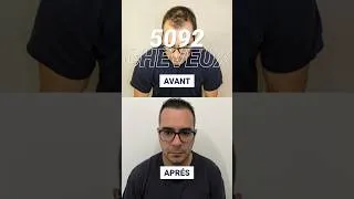 Miniature : Quel sera le naturel de votre ligne de cheveux après la greffe de cheveux ?
