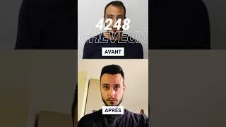 Miniature : Avant et après - Résultat de la greffe de cheveux de 12 mois #hairpalacebudapest