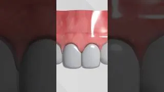 Miniature : Redresser ses dents avec INVISALIGN VS DOCTOR SMILE