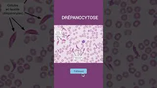 Miniature : DRÉPANOCYTOSE