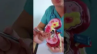 Miniature : Virus Hanta : Le virus mortel transmis par les souris 🤒 Fièvre + fatigue
