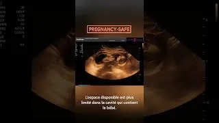 Miniature : Un bébé dans un utérus bicorne 🤰💙Comprendre pour mieux surveiller