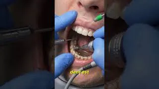 Miniature : Cette carie réparée par le dentiste en quelques minutes 🦷✨ #sshortsses