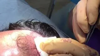 Miniature : Implantation de greffons FUE